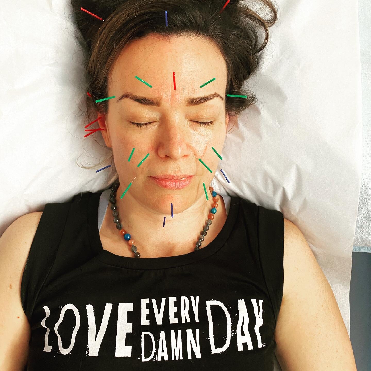 💕Love Every Damn Day.

💕And don&rsquo;t forget to love yourself first. Even if it means getting needles stuck in your face. 🤪

💕I promise it doesn&rsquo;t hurt. And leaves you glowing, inside and out. 

💕Remember to receive, especially if you&rs
