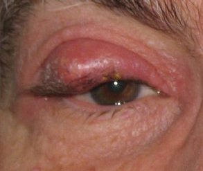 Red, painful eyelid? It might be a stye or a chalazion!