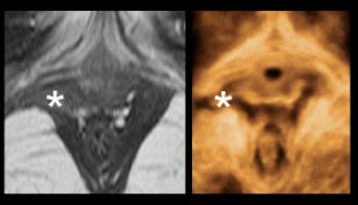 fig 3 avuls MR US.jpg