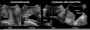 fig 2 diagnosis-prolapse.jpg
