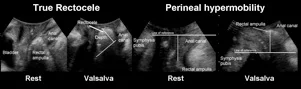fig 3 diagnosis-prolapse.jpg