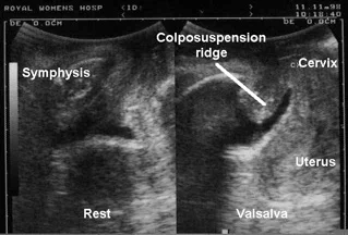 fig 1 incontinence surger adult.jpg