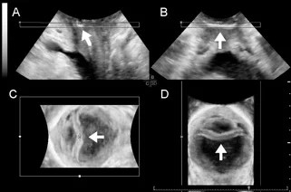 fig 5 incontinence surger adult.jpg