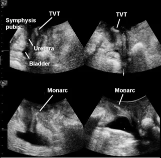 fig 6 incontinence surger adult.jpg