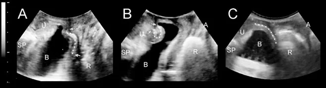 prolapse adult fig 4 1-2.jpg