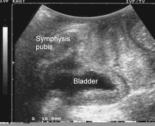 Blase ultraschall