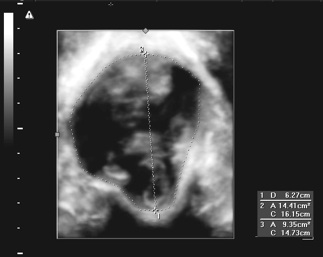 Levator Biomechanics fig 5.jpg