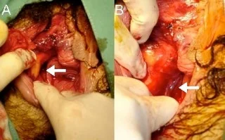 Levator Trauma fig 4.jpg