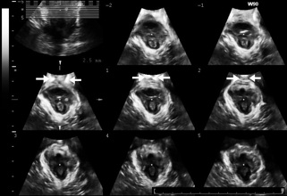 Levator Trauma fig 8.jpg