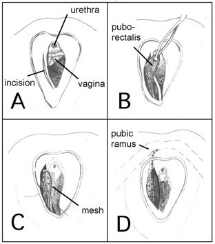 Levator Trauma fig 14 (OS).jpg