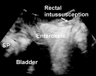 Obstructed Defecation fig 6.jpg