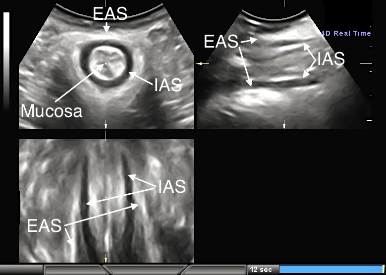 The Anal sphincter fig 2.jpg