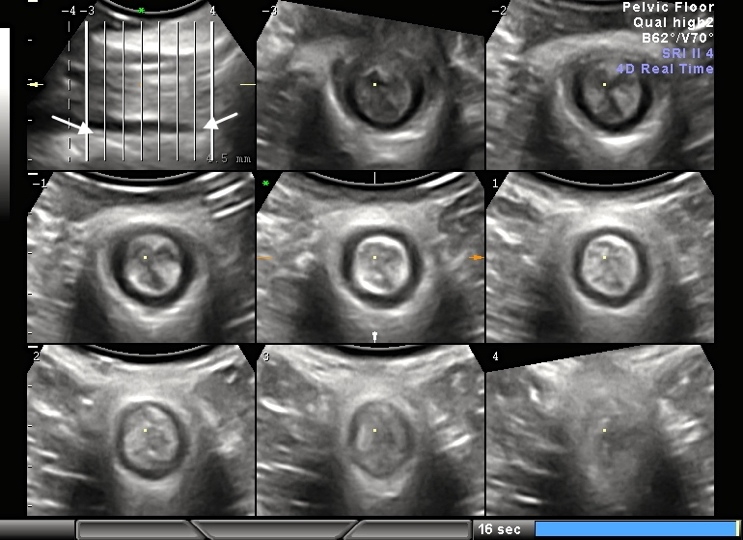 The Anal Sphincter fig 3.jpg
