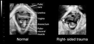 Clinical levator assessment fig 2.jpg