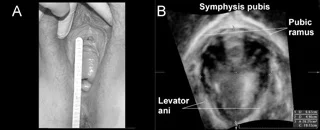 Clinical levator assessment fig 6.jpg