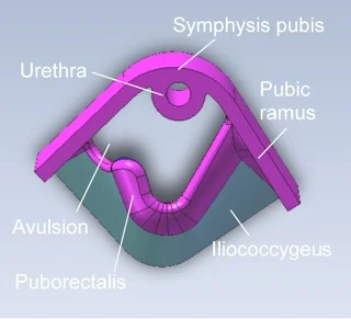Clinical levator assessment fig 7.jpg