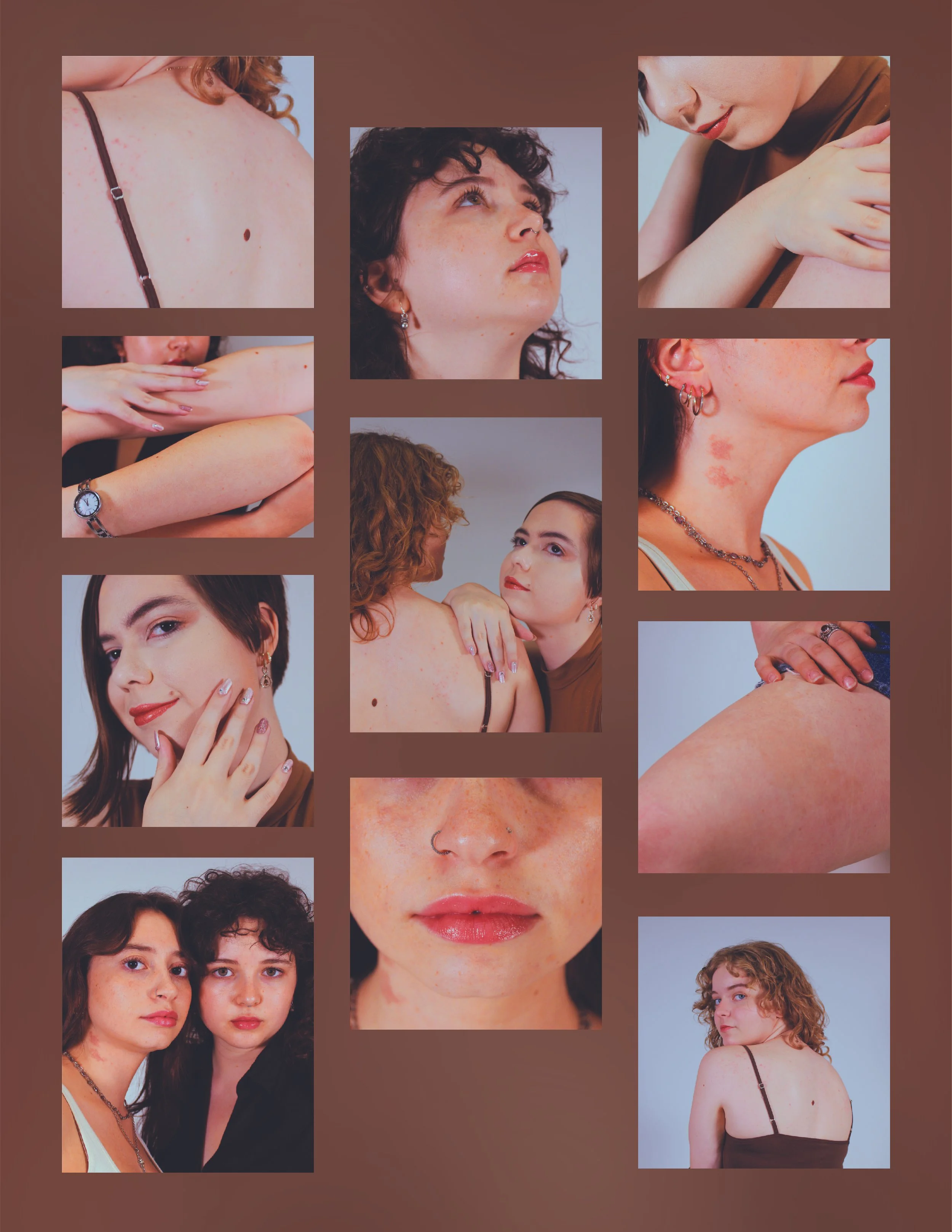 Beyond Skin Deep: The Beauty of Birthmarks