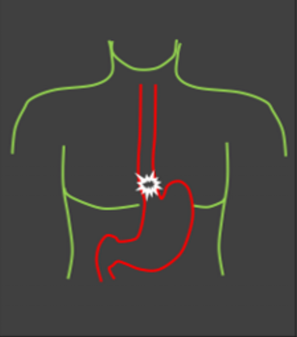 esophagus.png