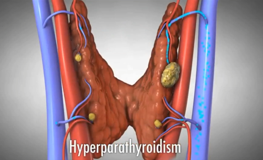 Parathyroid pic.png