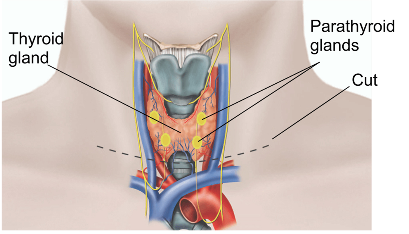 gs19_fig1_total-thyroidectomy-(for-thyrotoxicosis)-79559c.png