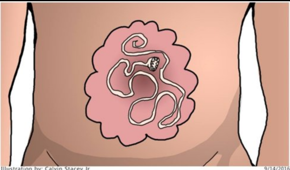 Hur blir man av med parasiter?