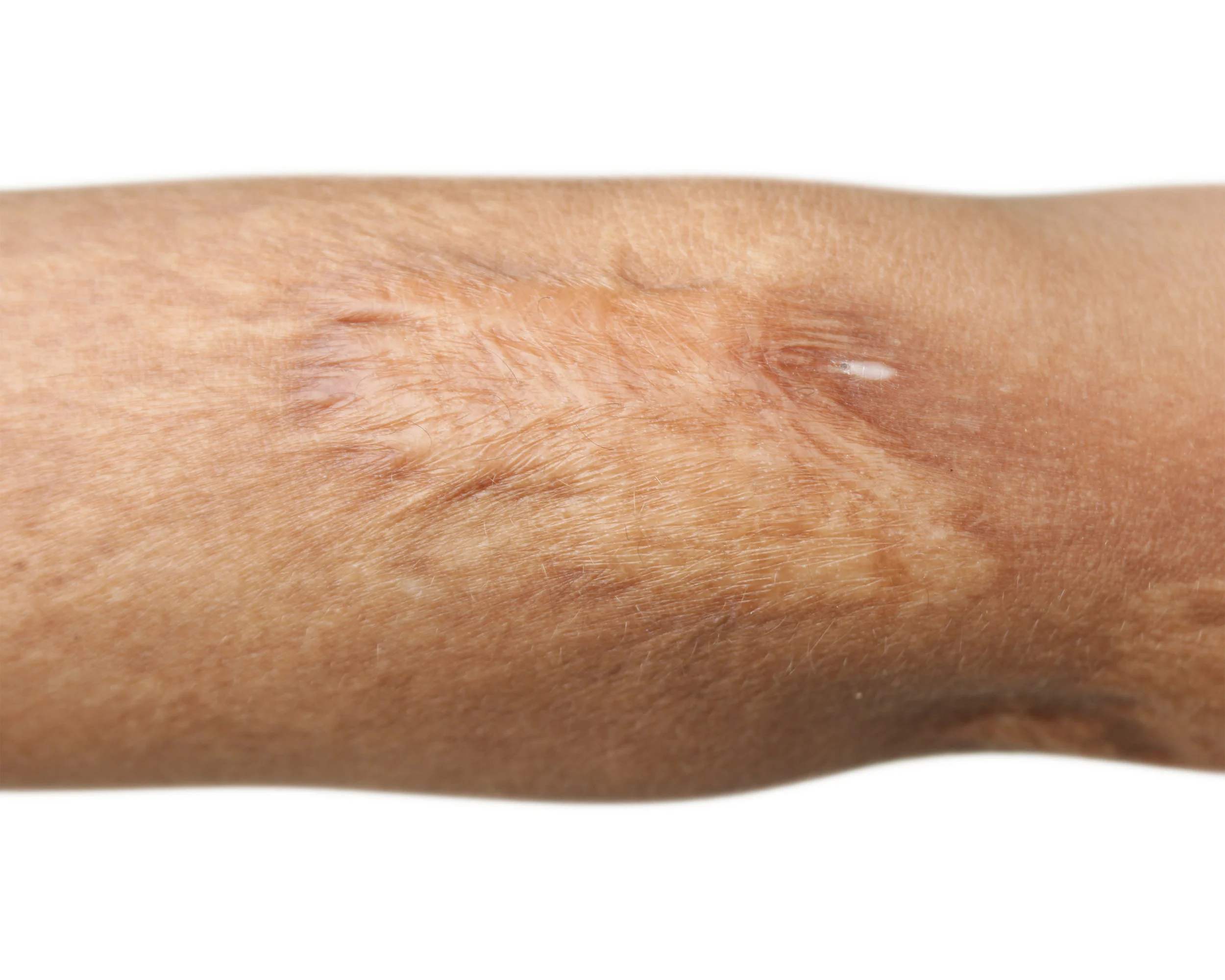 LOOK AND FEEL: Severe burns can cause loss of skin. The result is weblike in texture and marbelized in color.
