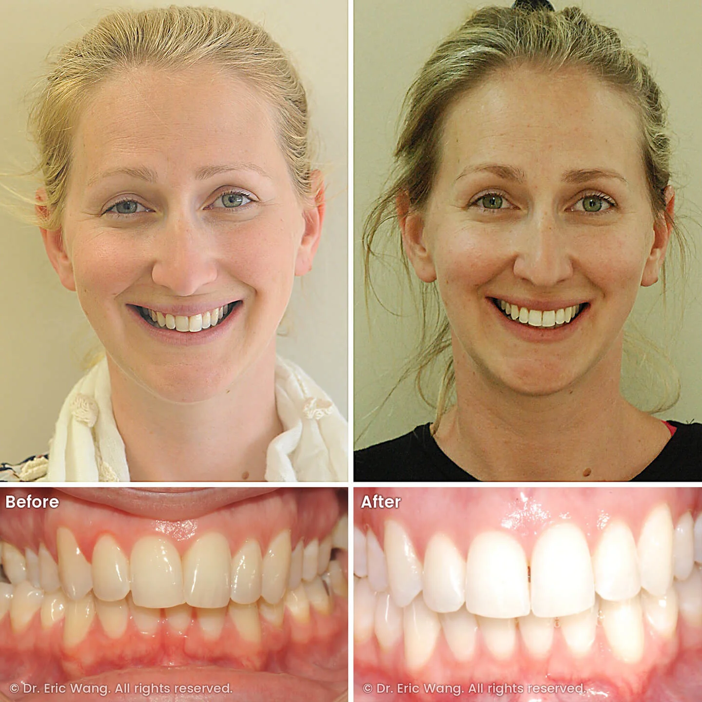 smile-docs-dr-eric-wang-cosmetic-dentist-before-after-sq-pg-damon-braces-03_LR_gallery.jpg