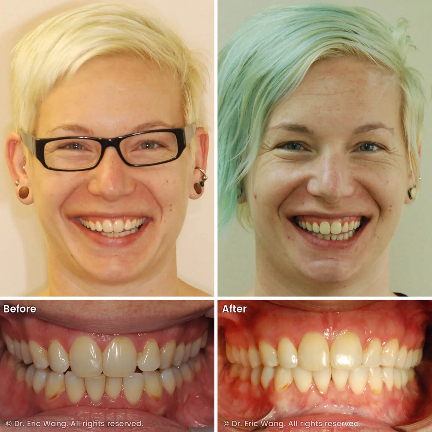 smile-docs-dr-eric-wang-cosmetic-dentist-before-after-sq-pg-damon-braces-04_LR_gallery.jpg