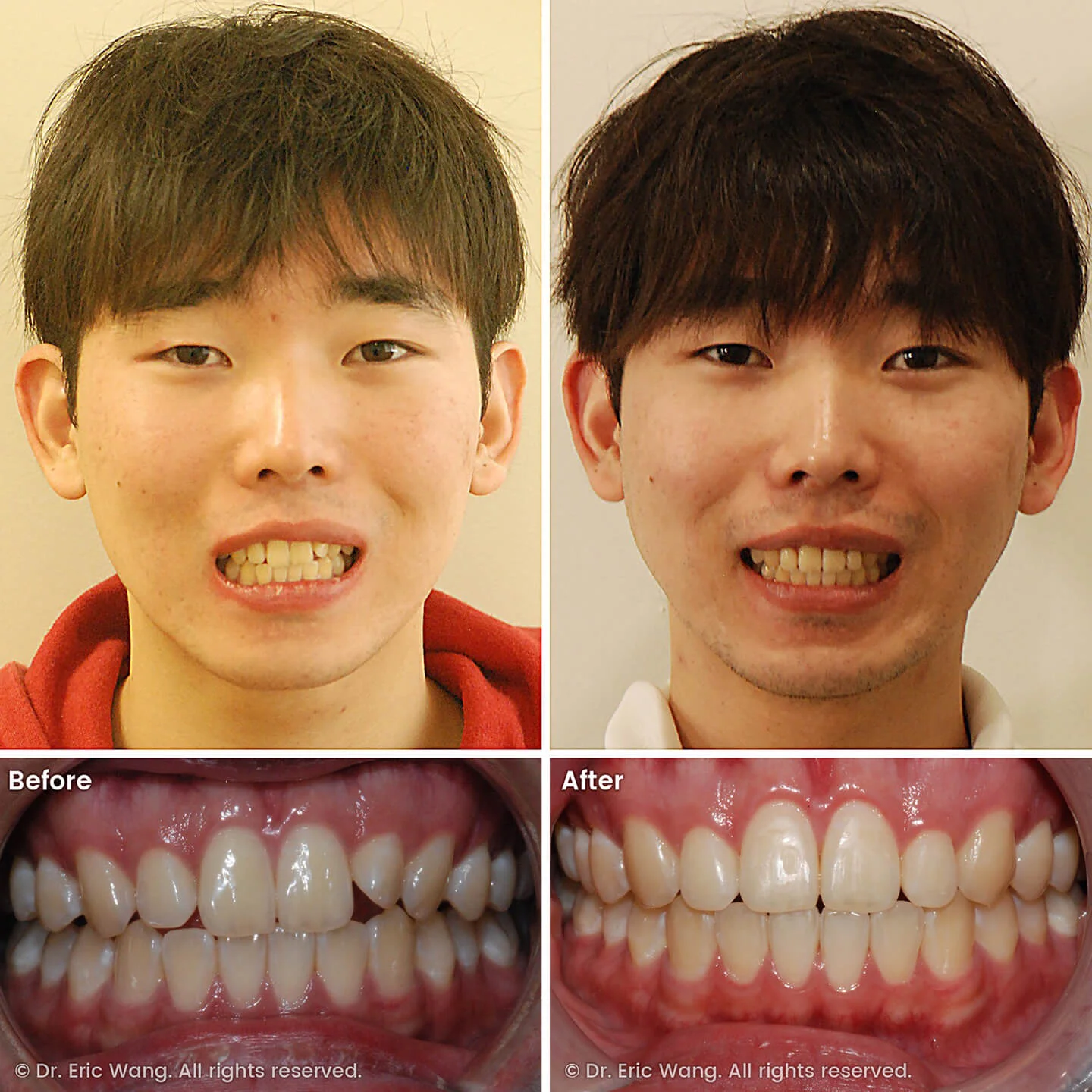 smile-docs-dr-eric-wang-cosmetic-dentist-before-after-sq-pg-damon-braces-05_LR_gallery.jpg