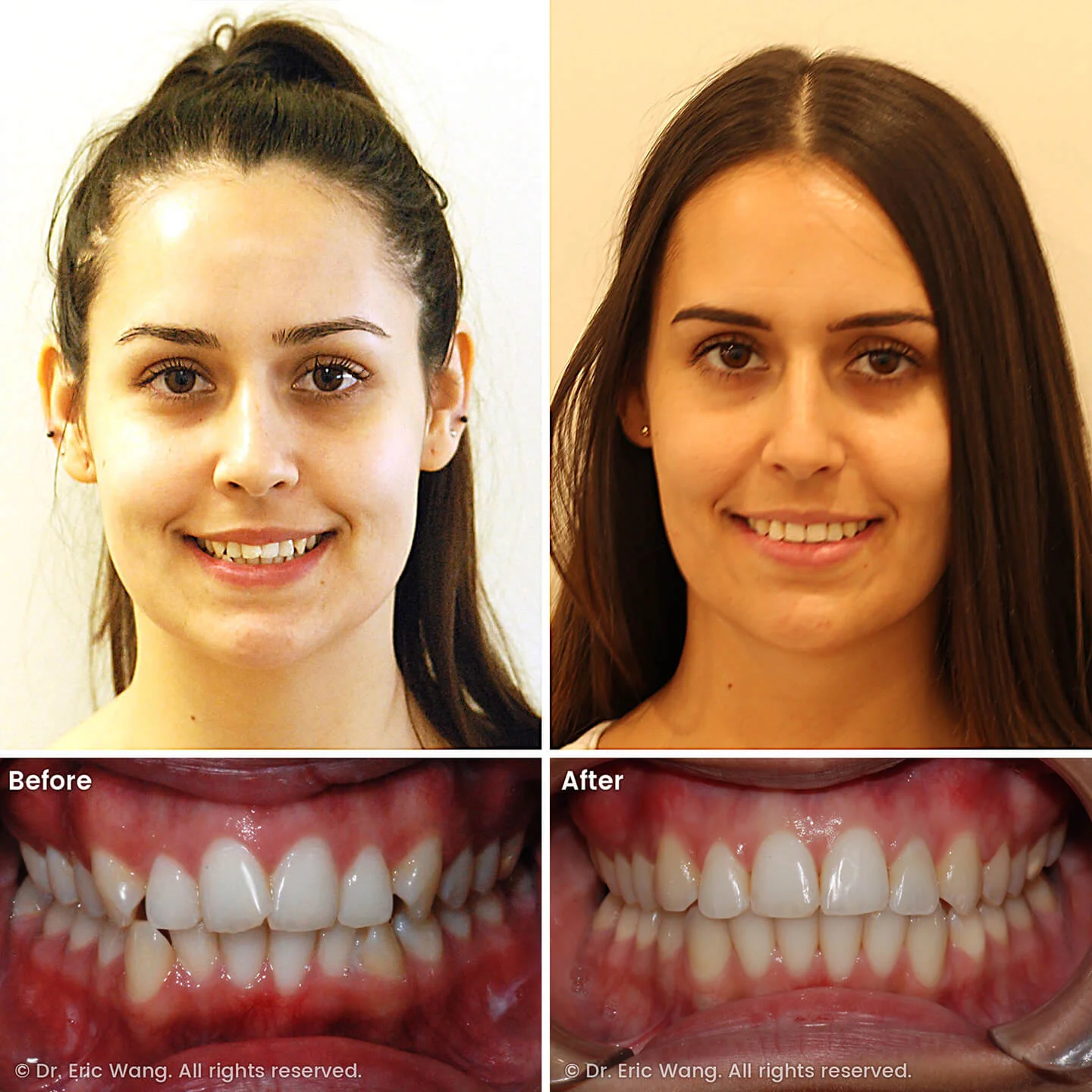 smile-docs-dr-eric-wang-cosmetic-dentist-before-after-sq-pg-damon-braces-08_LR_gallery.jpg
