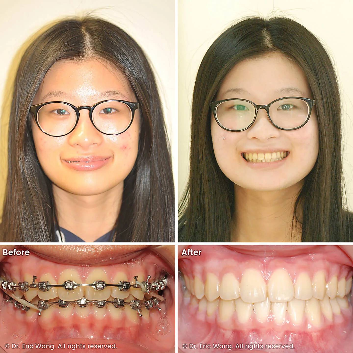 smile-docs-dr-eric-wang-cosmetic-dentist-before-after-sq-pg-damon-braces-09_LR_gallery.jpg