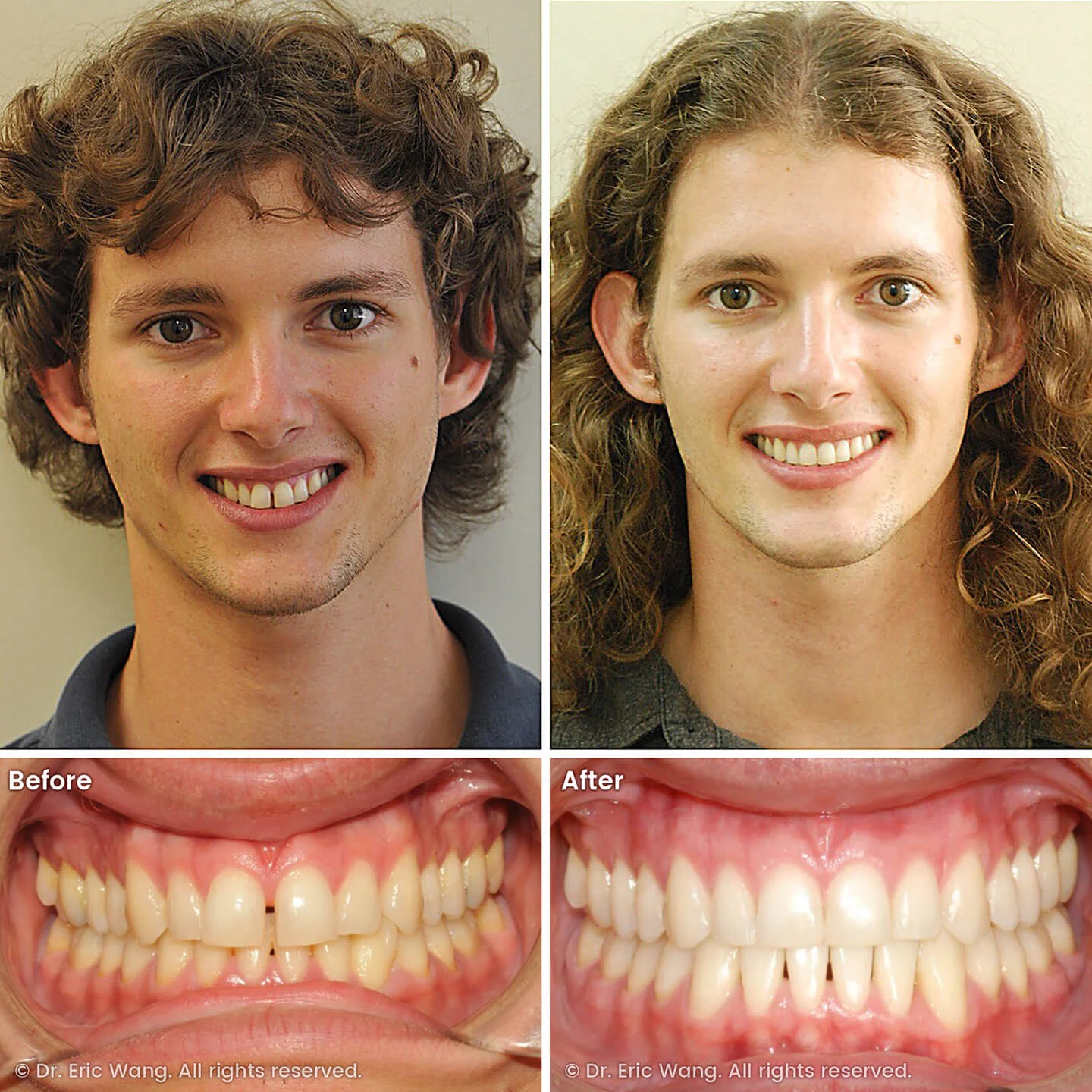 smile-docs-dr-eric-wang-cosmetic-dentist-before-after-sq-pg-damon-braces-10_LR_gallery.jpg