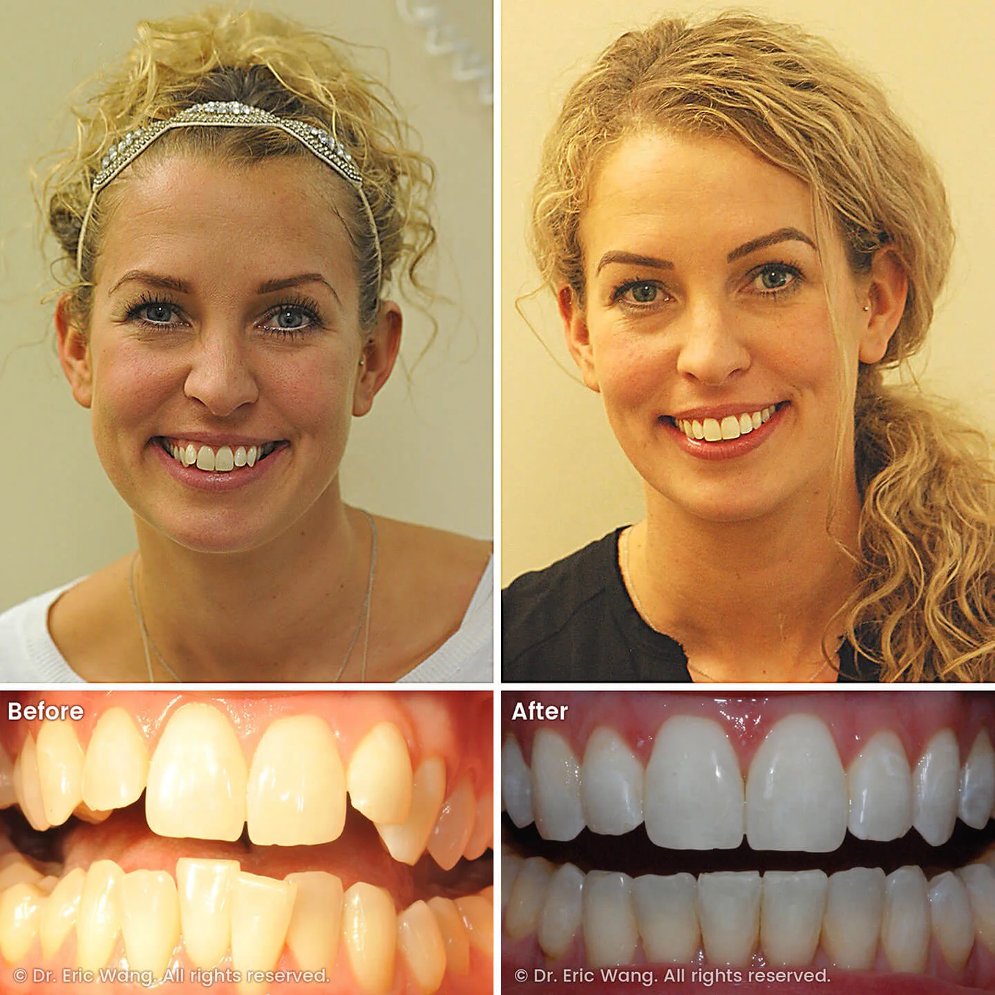 smile-docs-dr-eric-wang-cosmetic-dentist-before-after-sq-pg-damon-braces-12_LR_gallery.jpg