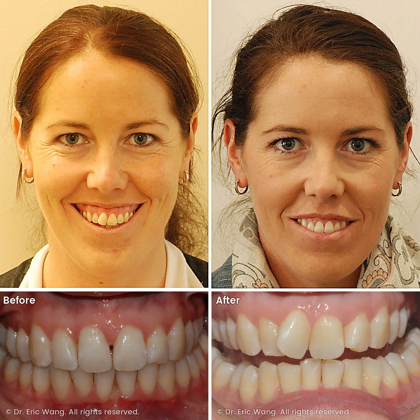 smile-docs-dr-eric-wang-cosmetic-dentist-before-after-sq-pg-damon-braces-13_LR_gallery.jpg