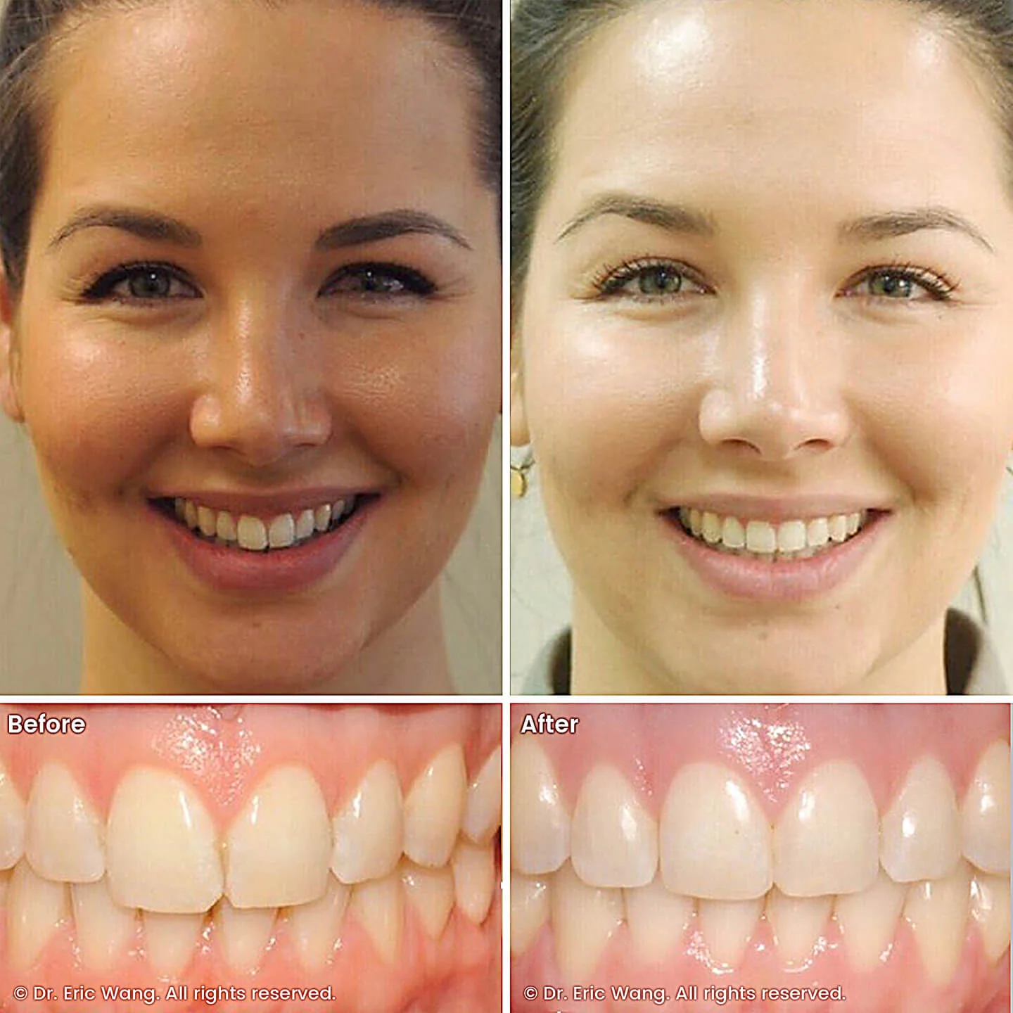 smile-docs-dr-eric-wang-cosmetic-dentist-before-after-sq-pg-damon-braces-17_LR_gallery.jpg
