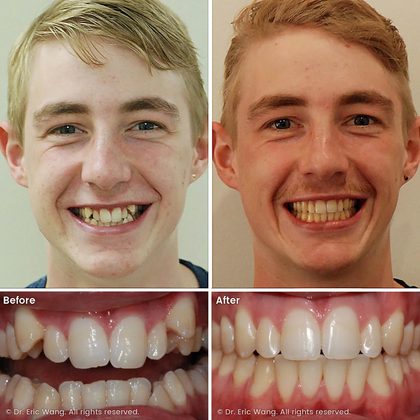 smile-docs-dr-eric-wang-cosmetic-dentist-before-after-sq-pg-kids-orthodontics-01_LR_gallery.jpg