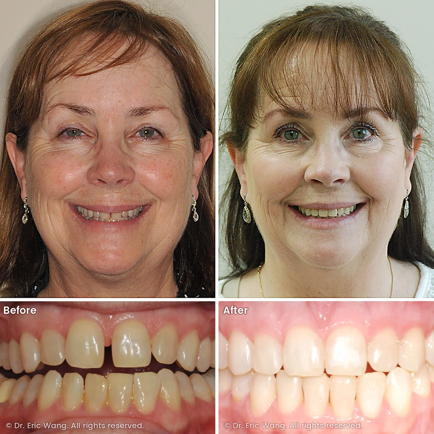 smile-docs-dr-eric-wang-cosmetic-dentist-before-after-sq-pg-neuromuscular-ortho-01_LR_gallery.jpg