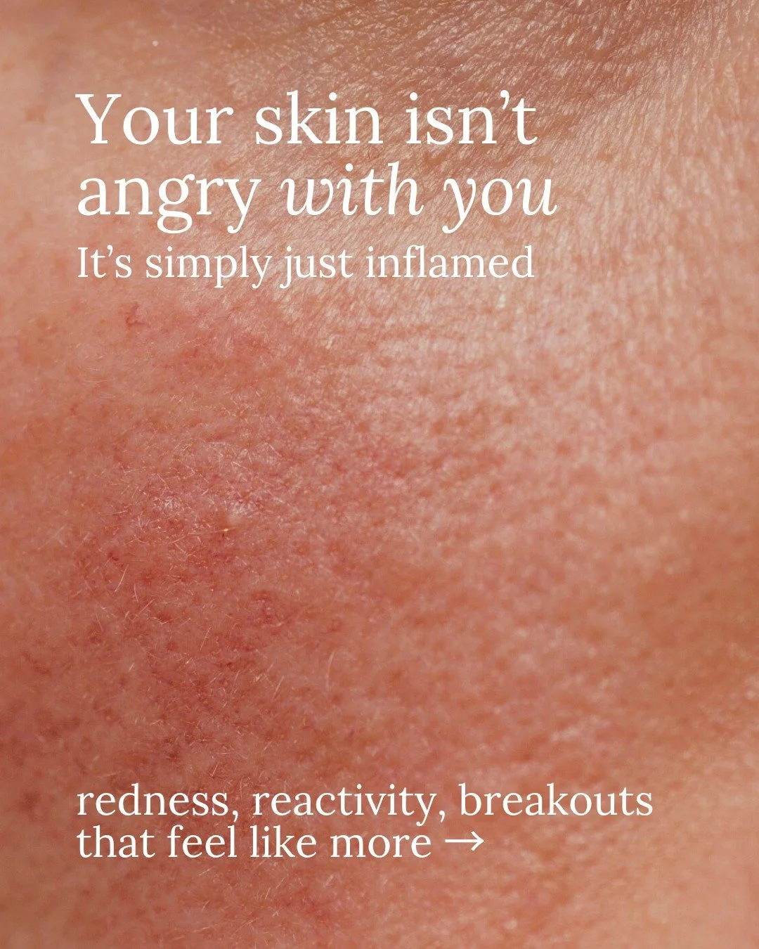 If your skin has been louder than usual lately, flushing, breaking out, reacting to things it didn't react to a month ago, this one is for you.
 
Inflamed skin doesn't usually need stronger products. It needs the system underneath it to settle.
 
My 
