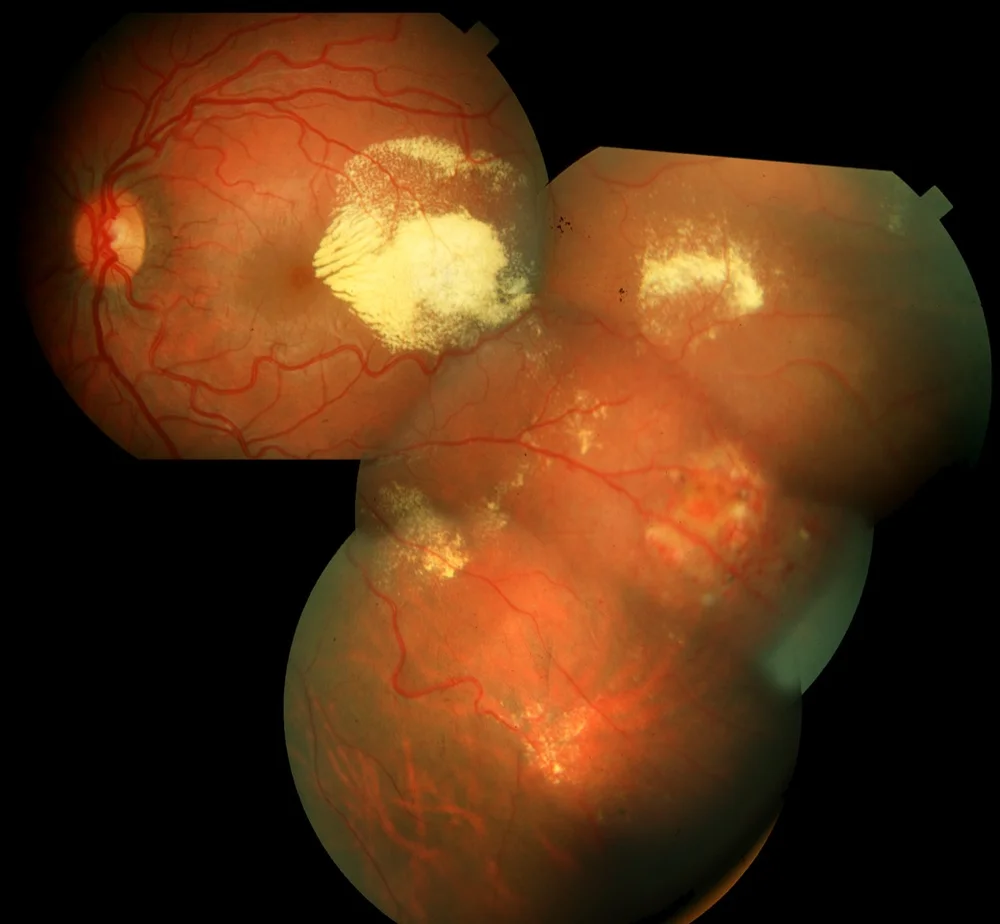 Coats' Disease — Pediatric Retinal Research Foundation