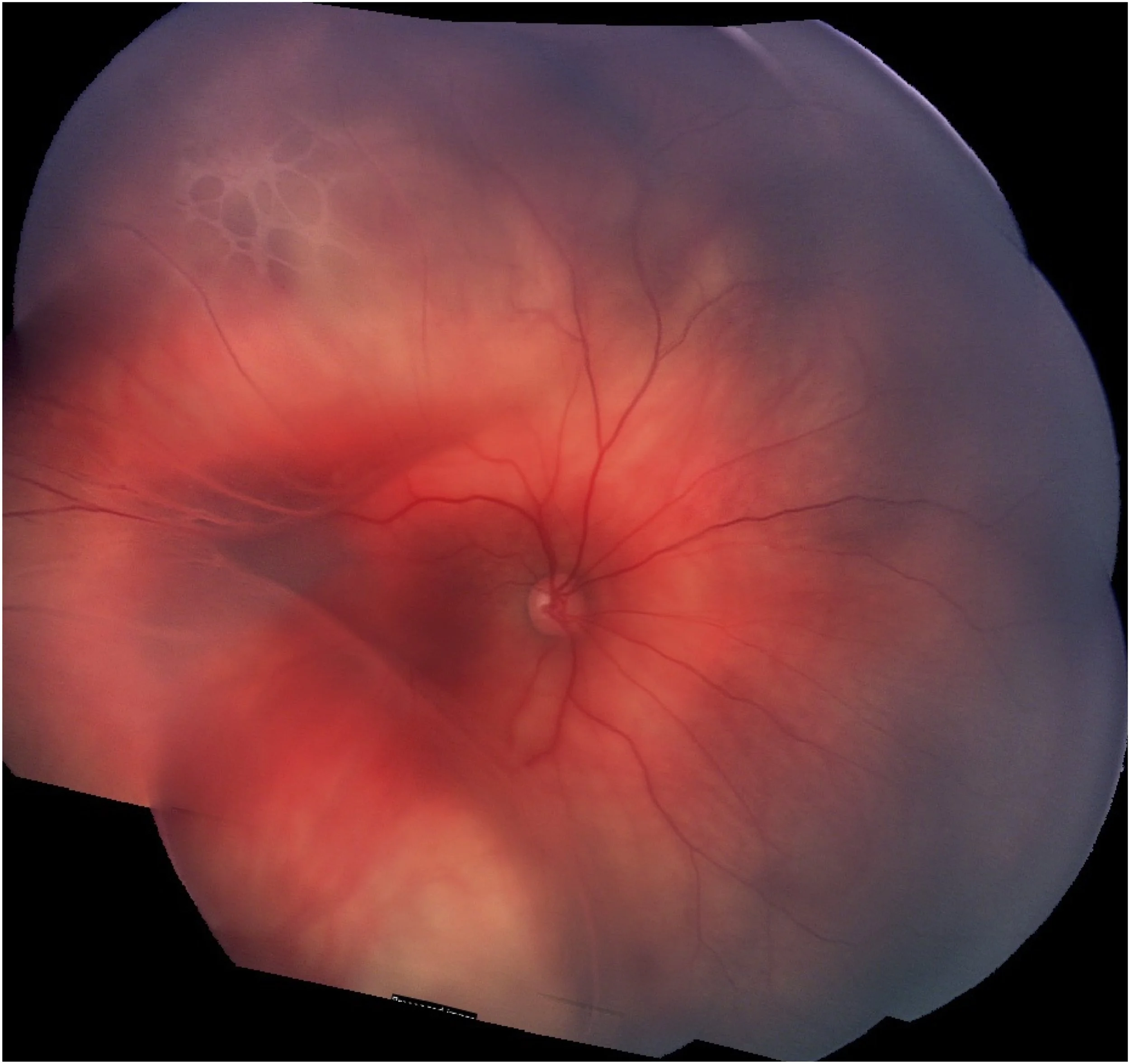 Retinoschisis — Pediatric Retinal Research Foundation