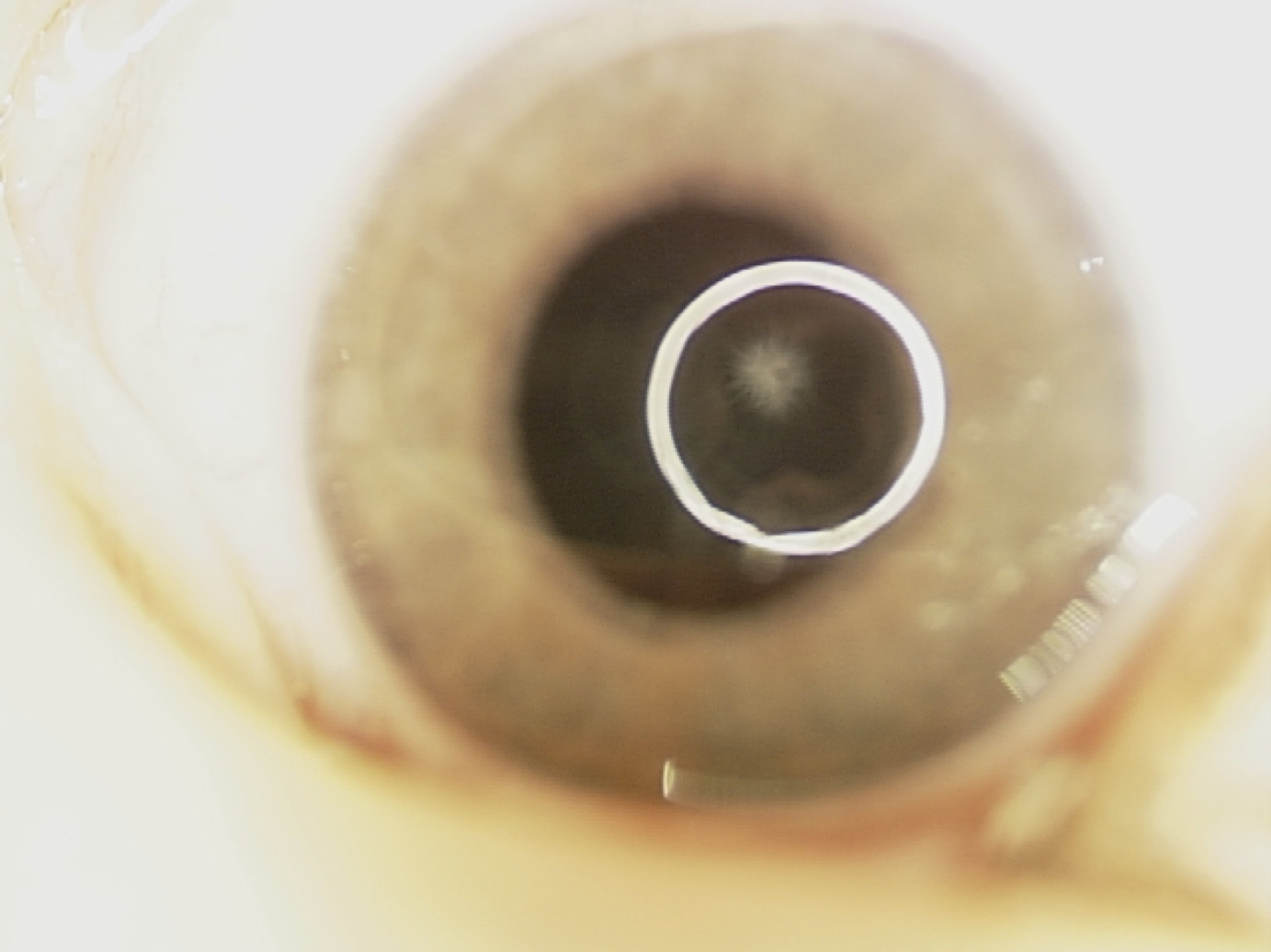 PFVS — Pediatric Retinal Research Foundation