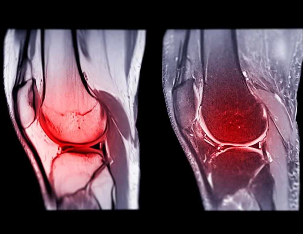 All About ACL Ruptures — Suzie Foreman Physiotherapy