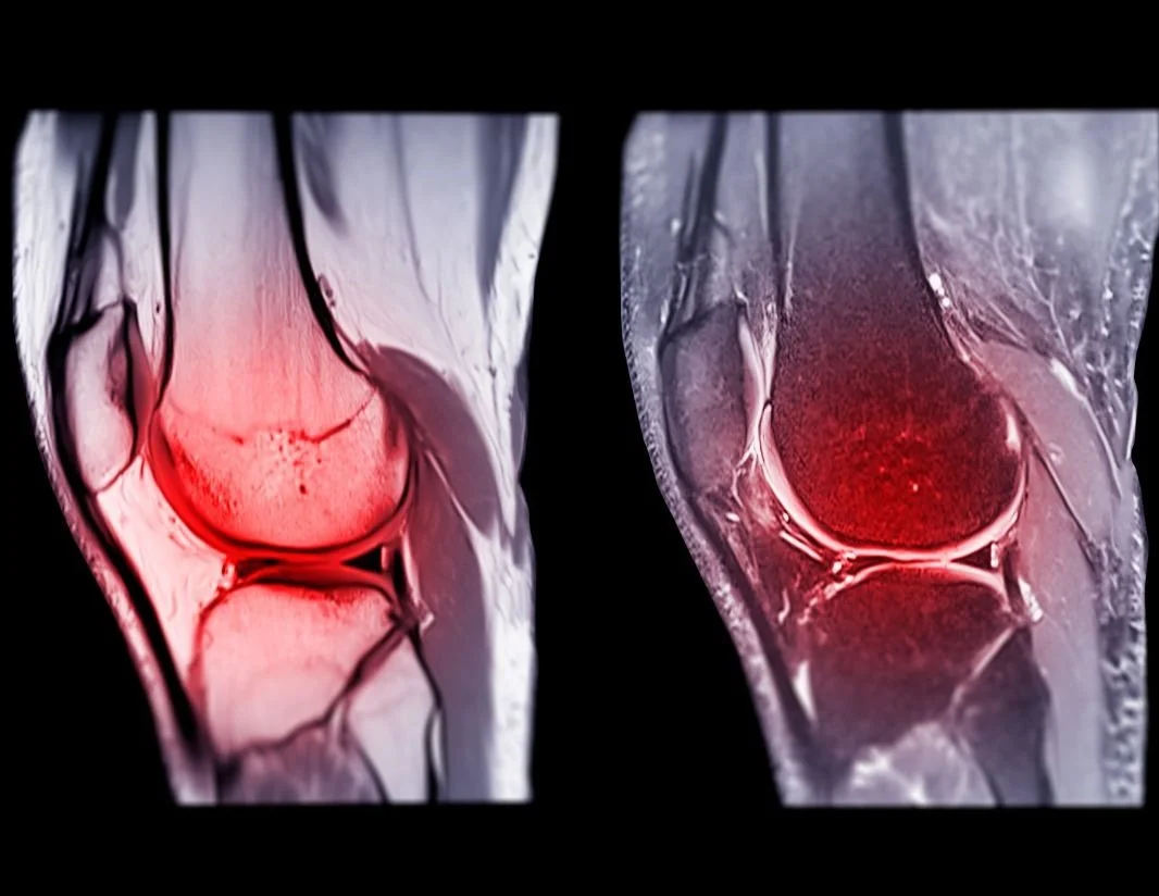 All About ACL Ruptures — Suzie Foreman Physiotherapy