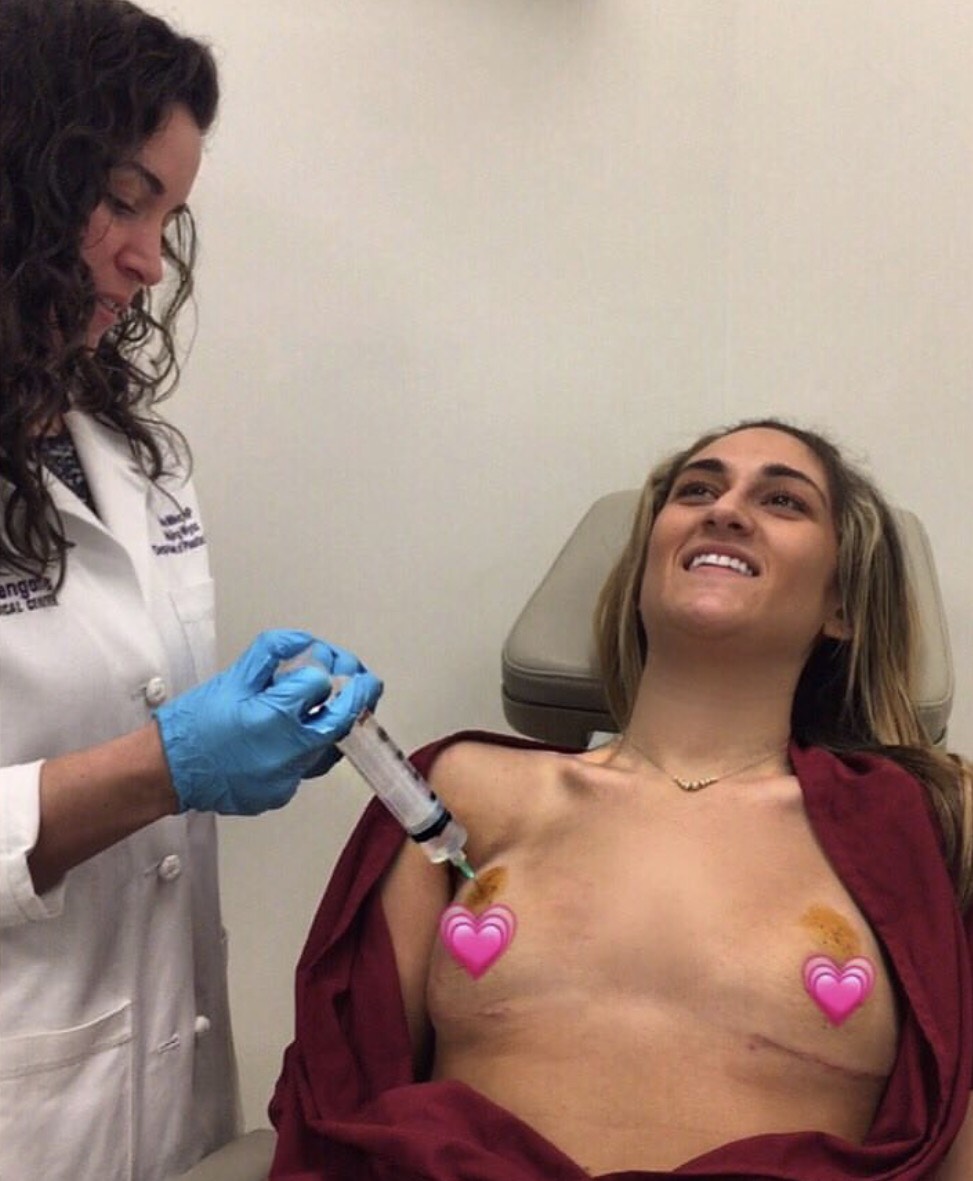 My first fill really wasn't bad! Because I didn't have much feeling in my chest, I could barely feel the needles going in. It just felt like a slight prick. The worst part was having my doctor clean off the iodine because my skin was still so sensitive. They filled me with 60 cc's for my first fill. After the fill my back was tight but it really wasn't too bad!! 