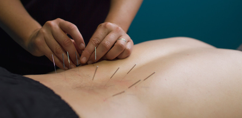 DRY NEEDLING