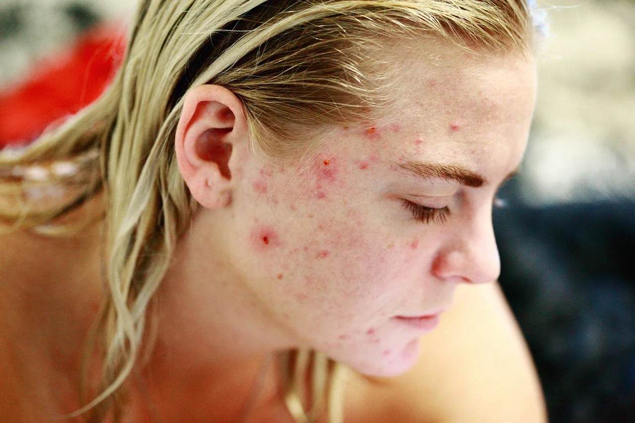 acne.jpg