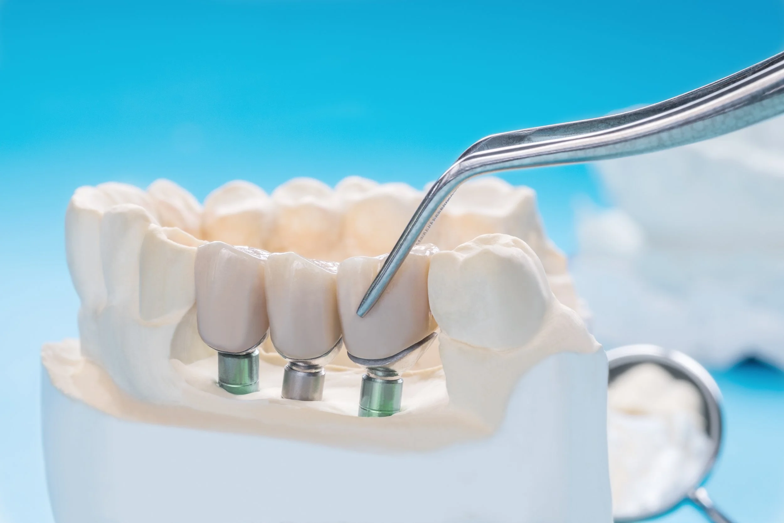 close-up-implan-model-tooth-support-fix-bridge-implan-crown.jpg
