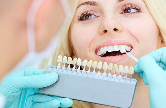 veneers.png