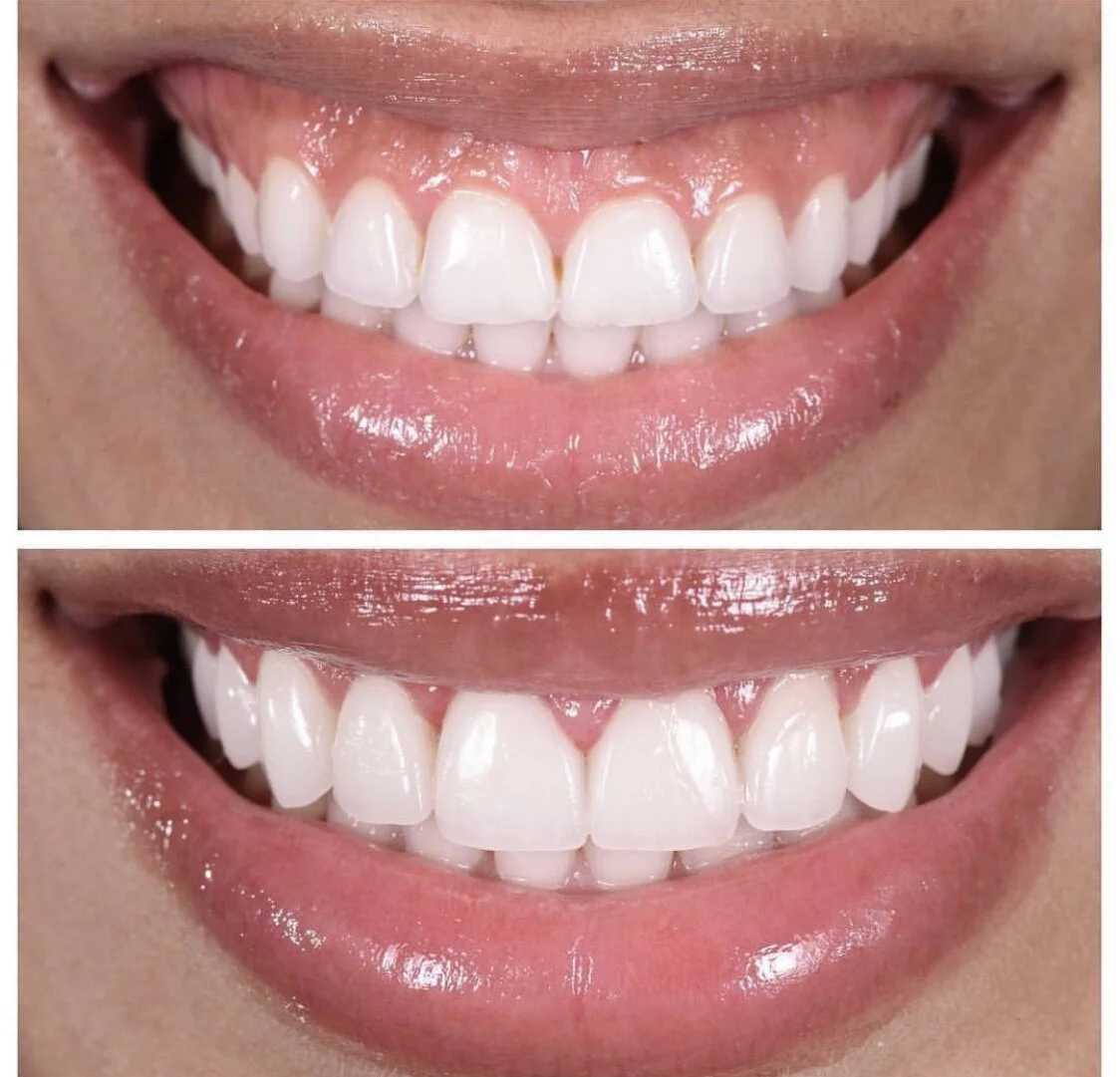 Lumineers — Boston Dental Design