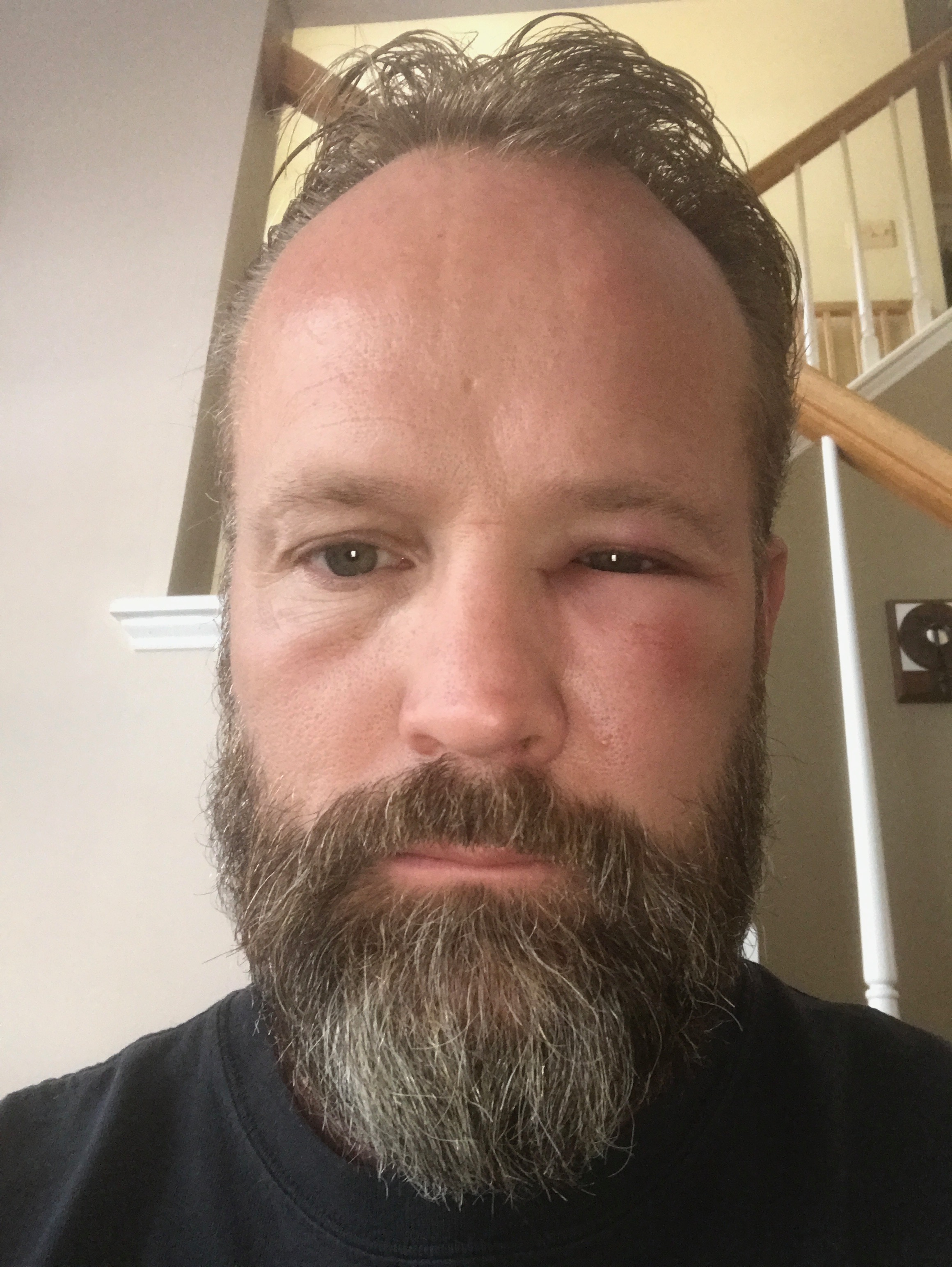 OUCH! Stung in the face.
